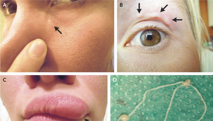 Занесенный московским комаром паразит увеличил губы ростовчанке