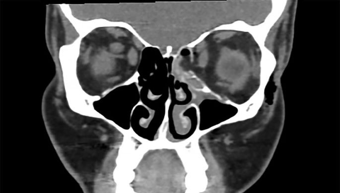 Британка хотела высморкаться, но сломала глазницу и бросила курить