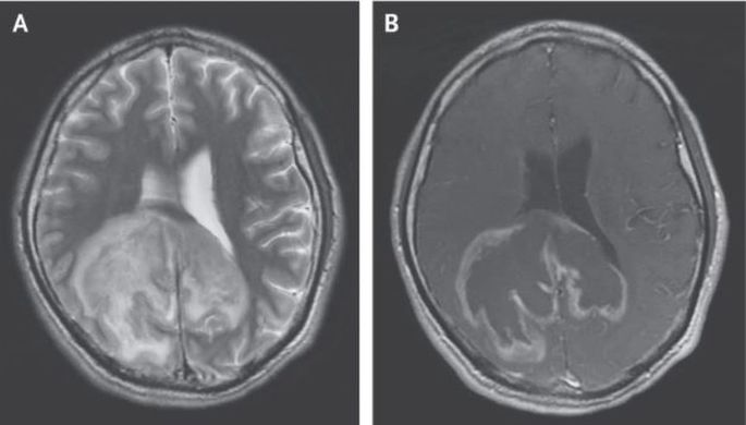 В России обнаружили новую редкую форму атрофии мозга