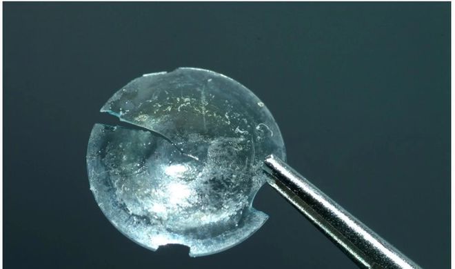 Врачи удалили из глаза женщины линзу, пробывшую там 28 лет