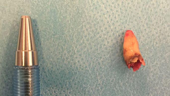 У датчанина в носу вырос зуб