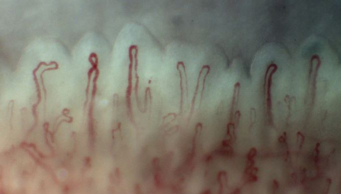 Для оценки состояния сосудов предложен комплексный метод