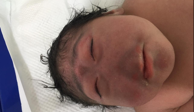 В Ираке родился ребенок без носа