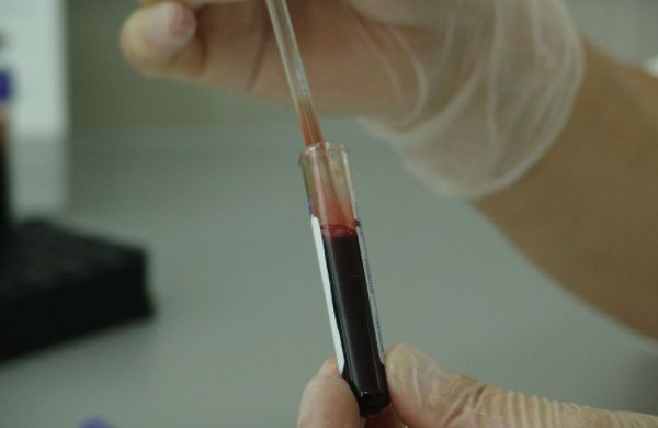 Ученые сообщили о третьем случае излечения от ВИЧ