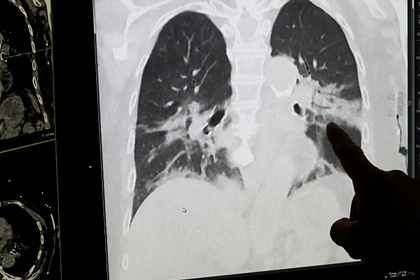 Найден способ спасать легкие пациентов с&nbsp;коронавирусом
