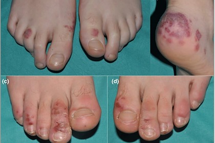 Нетипичный симптом коронавируса показали на&nbsp;фотографиях