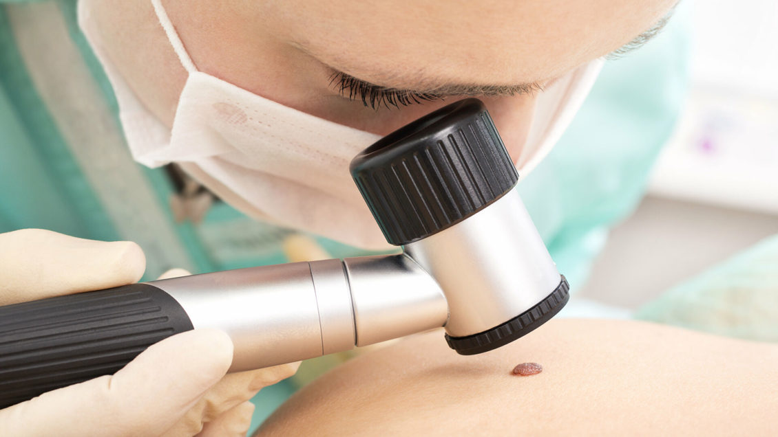 Назван главный симптом рака кожи