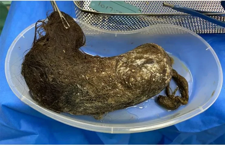 Британка порвала желудок собственными волосами