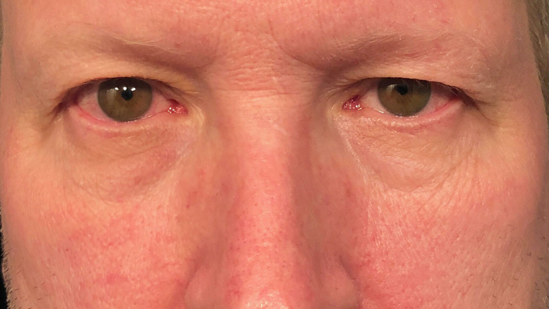 Обнаружено новое осложнение при тяжелой форме COVID-19