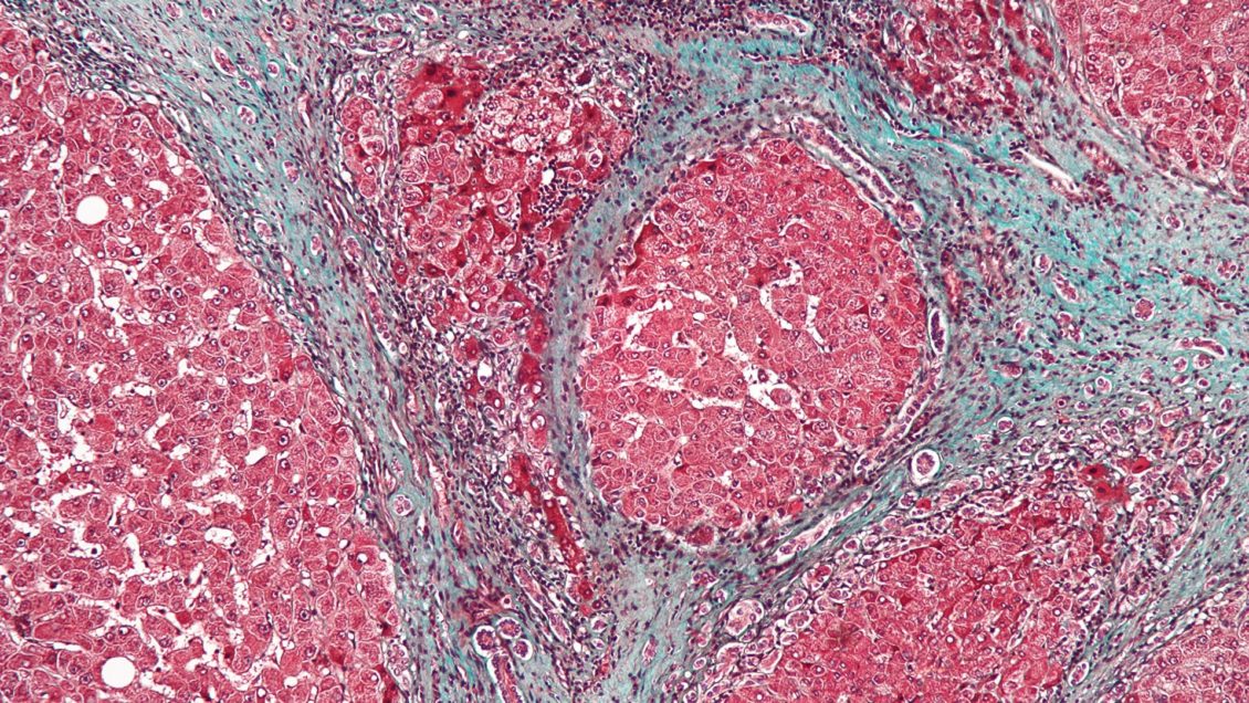 Названы необычные симптомы цирроза печени