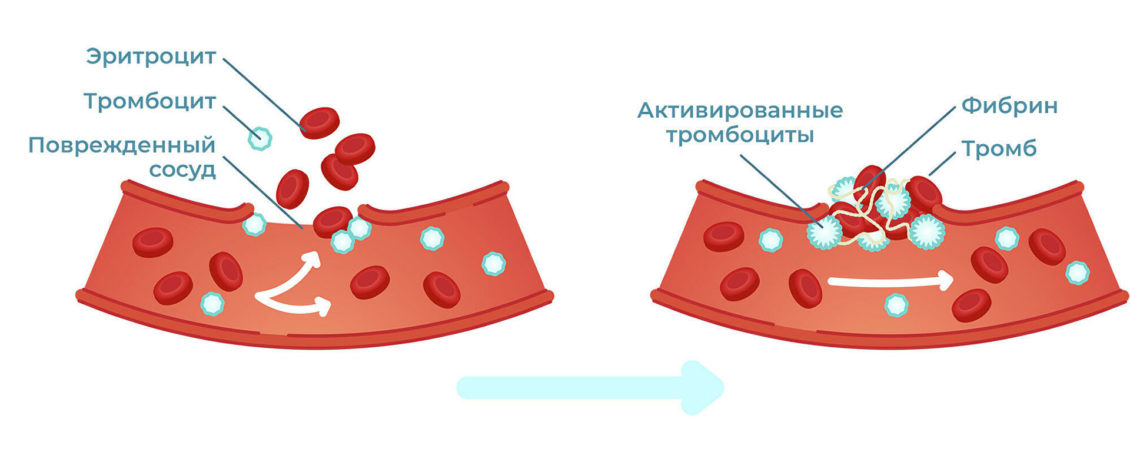 "Страдают легкие". Ученые рассказали о риске тромбоза при COVID-19
