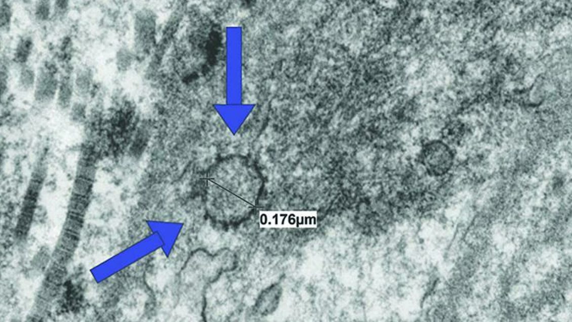 Ученые выяснили, как коронавирус влияет на потенцию