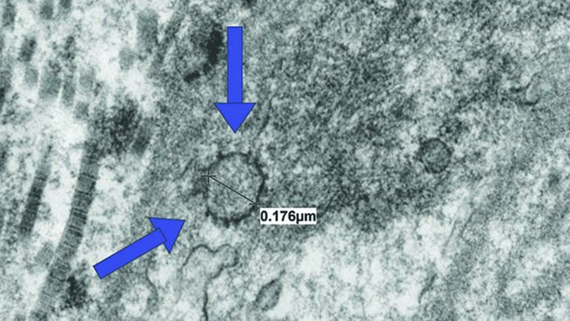 Ученые назвали основные симптомы постковидного синдрома