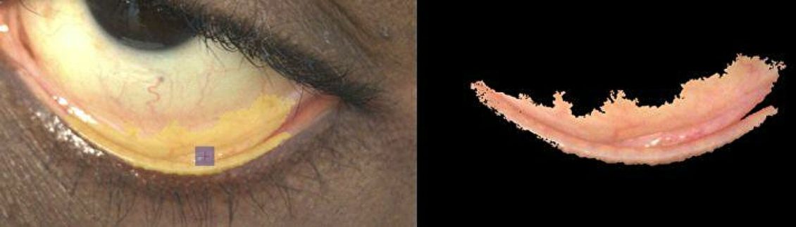 Разработан метод диагностики опасного заболевания по селфи со смартфона Разработан метод диагностики опасного заболевания по селфи со смартфона