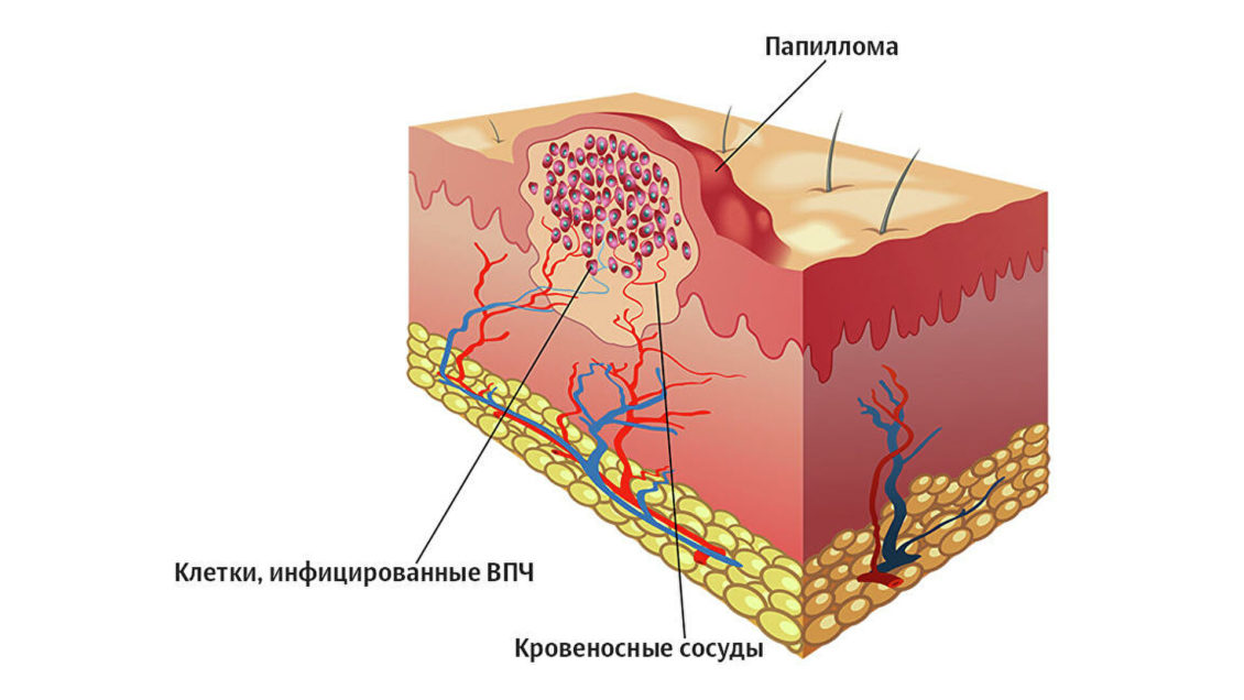 Три вида рака, которые могут исчезнуть в ближайшие десятилетия Три вида рака, которые могут исчезнуть в ближайшие десятилетия