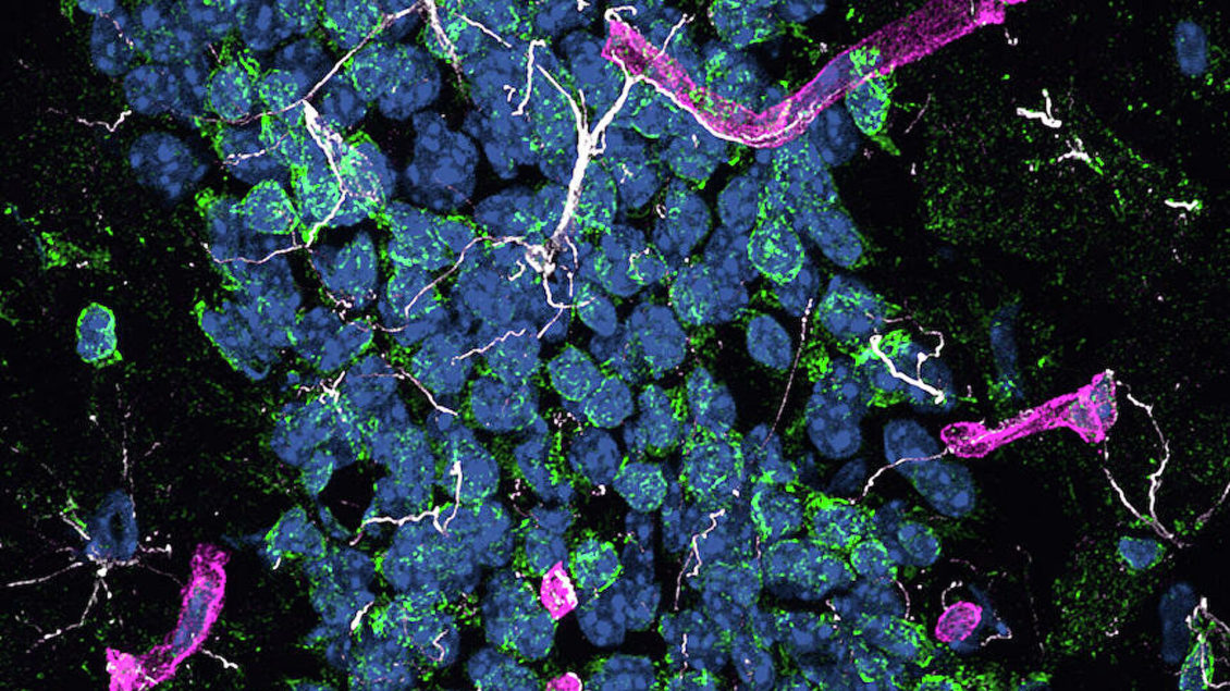Ученые рассказали, как избежать болезни Альцгеймера Ученые рассказали, как избежать болезни Альцгеймера