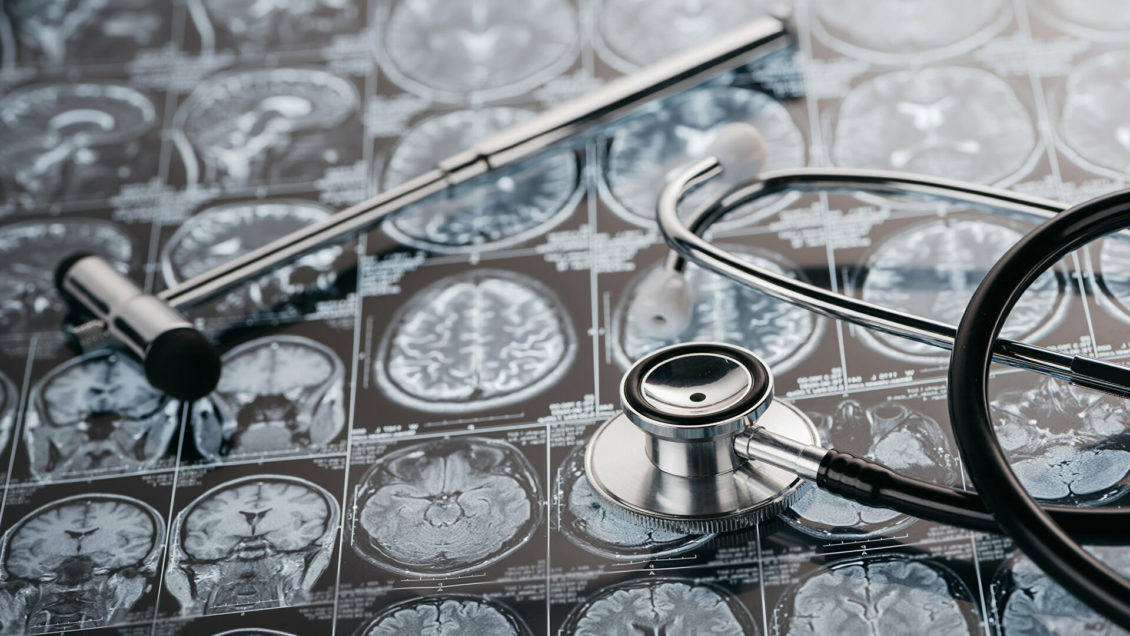 Раскрыта внезапная причина деменции