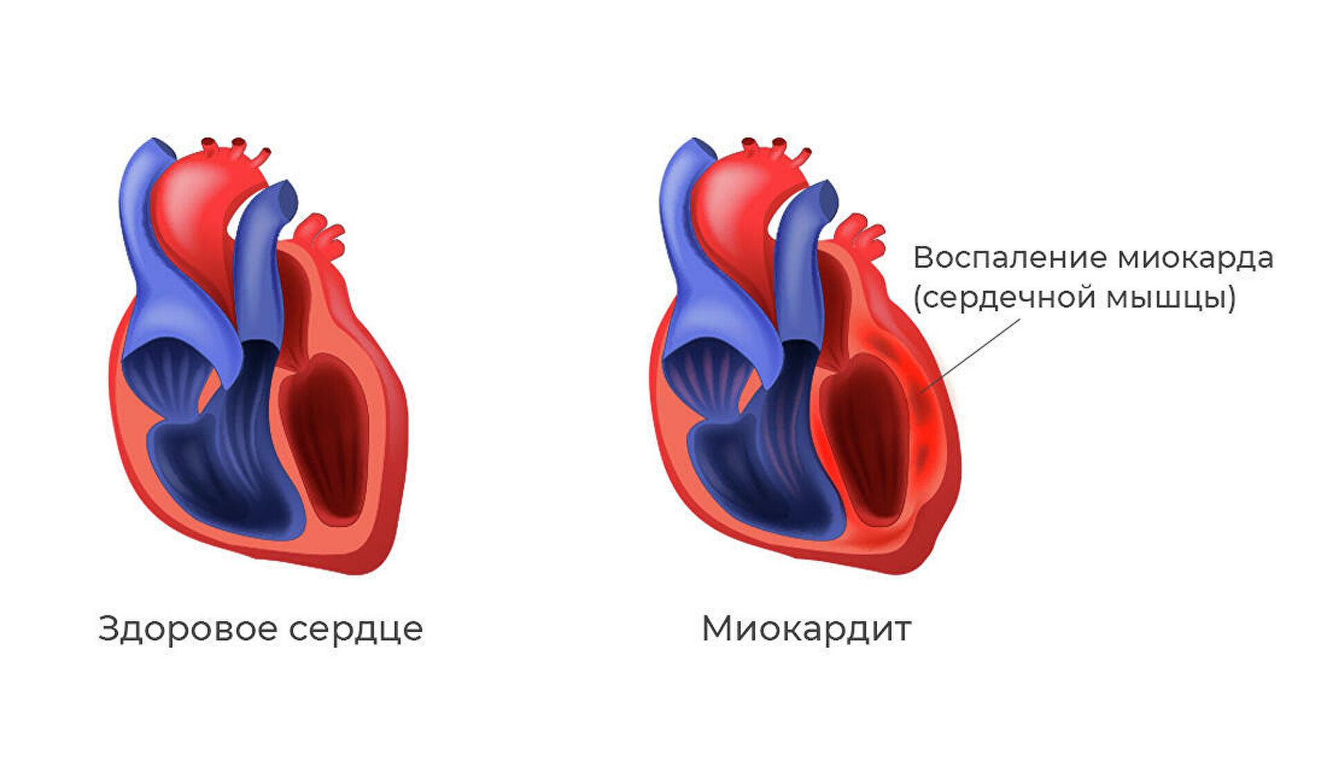 Прихватило сердце. Врачи рассказали об опаснейшем осложнении COVID-19 Прихватило сердце. Врачи рассказали об опаснейшем осложнении COVID-19