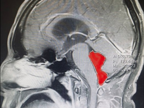 Американец прожил 10 лет с червем в мозге Американец прожил 10 лет с червем в мозге